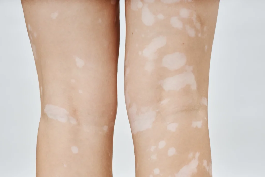 Aplicación de tratamiento dermatológico para manchas blancas en la piel