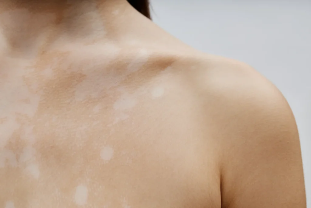 Ejemplo de manchas blancas en la piel causadas por hongos