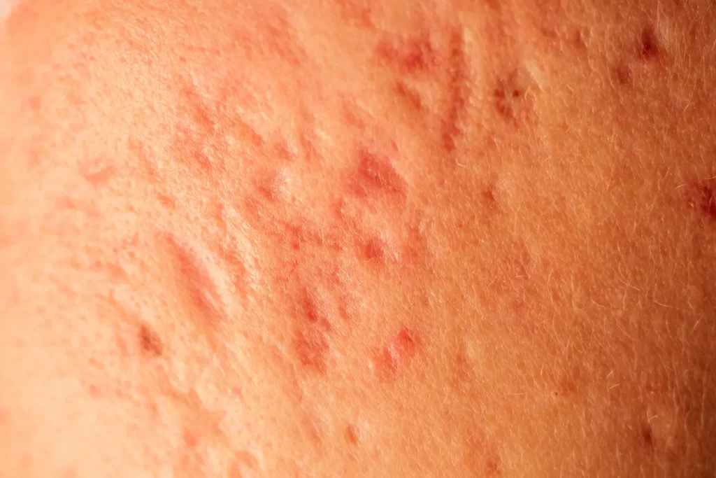Mujer adulta con acné hormonal en zona mandibular antes y después del tratamiento dermatológico