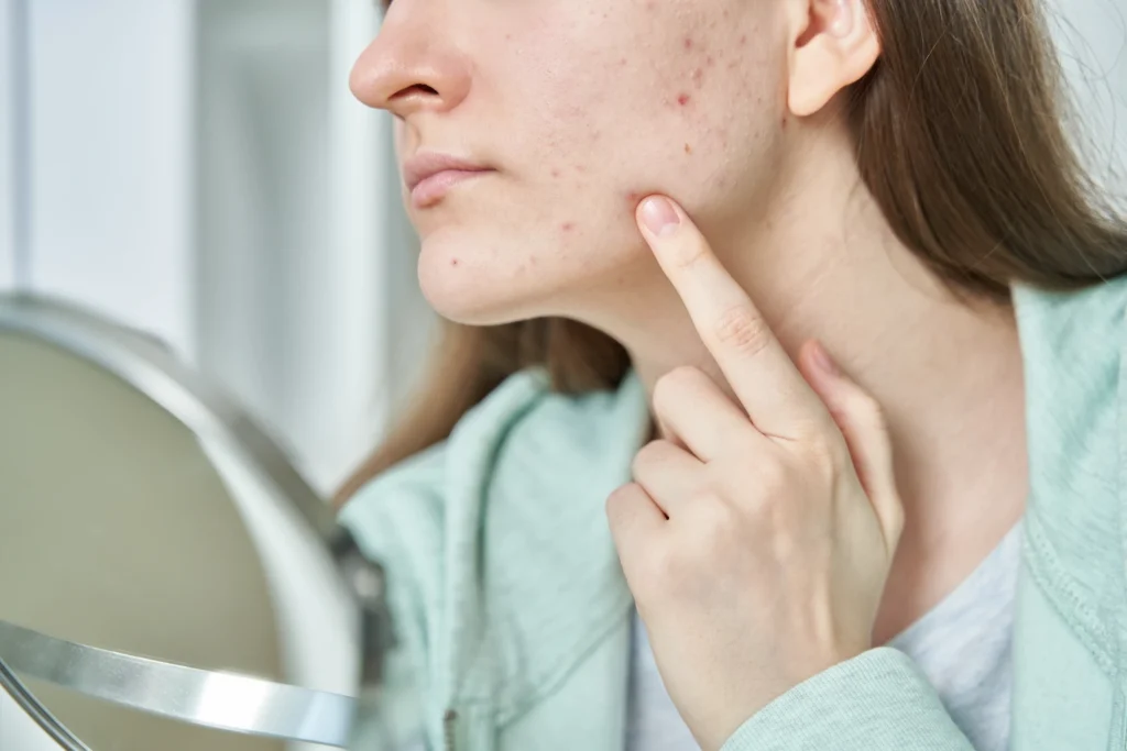 Mujer joven con acné vulgar en el rostro mirándose al espejo con expresión reflexiva