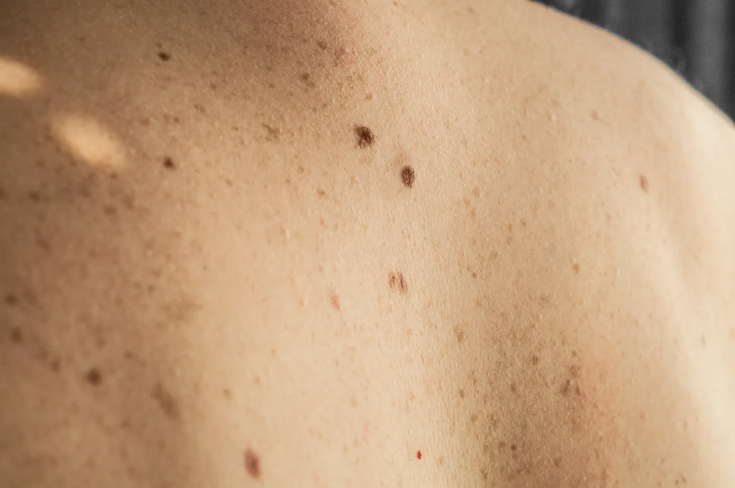 Mujer joven mostrando manchas negras en la piel del rostro durante una revisión dermatológica
