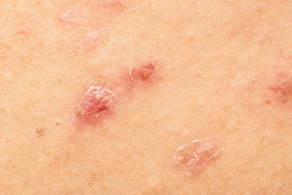 Paciente con manchas blancas en la piel siendo evaluada con luz de Wood en consulta dermatológica