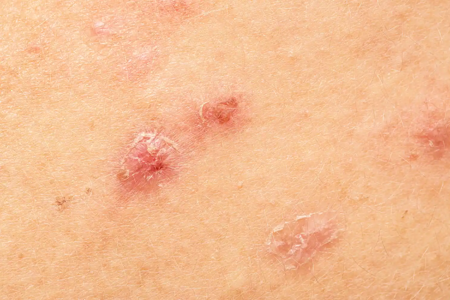 Paciente con manchas blancas en la piel siendo evaluada con luz de Wood en consulta dermatológica