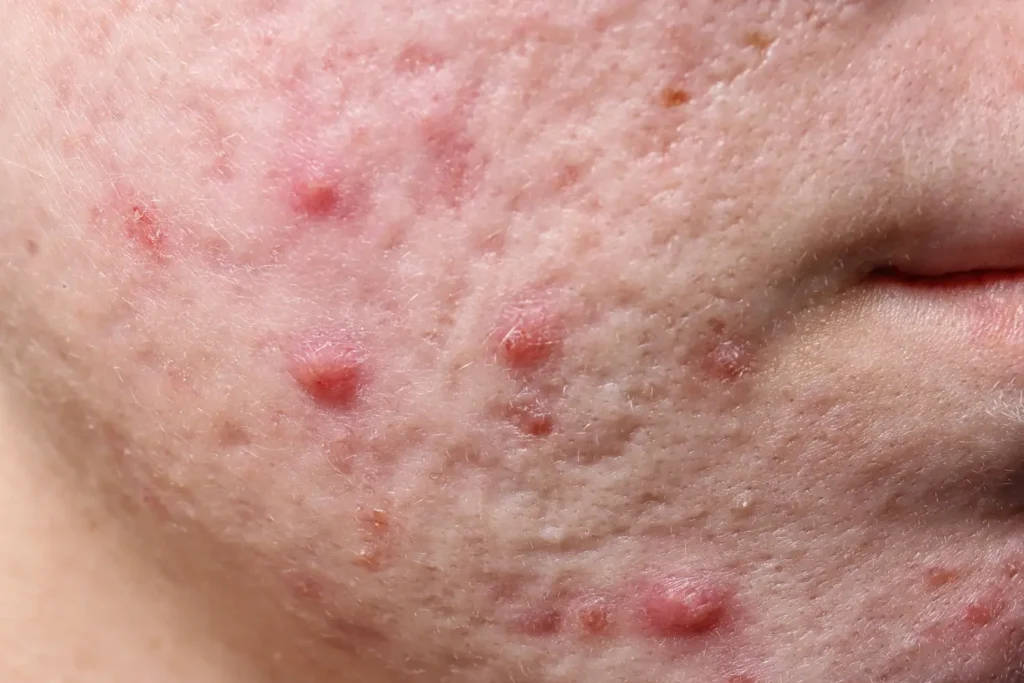 Primer plano de piel con secuelas de acné en mejillas, mostrando cicatrices y manchas oscuras