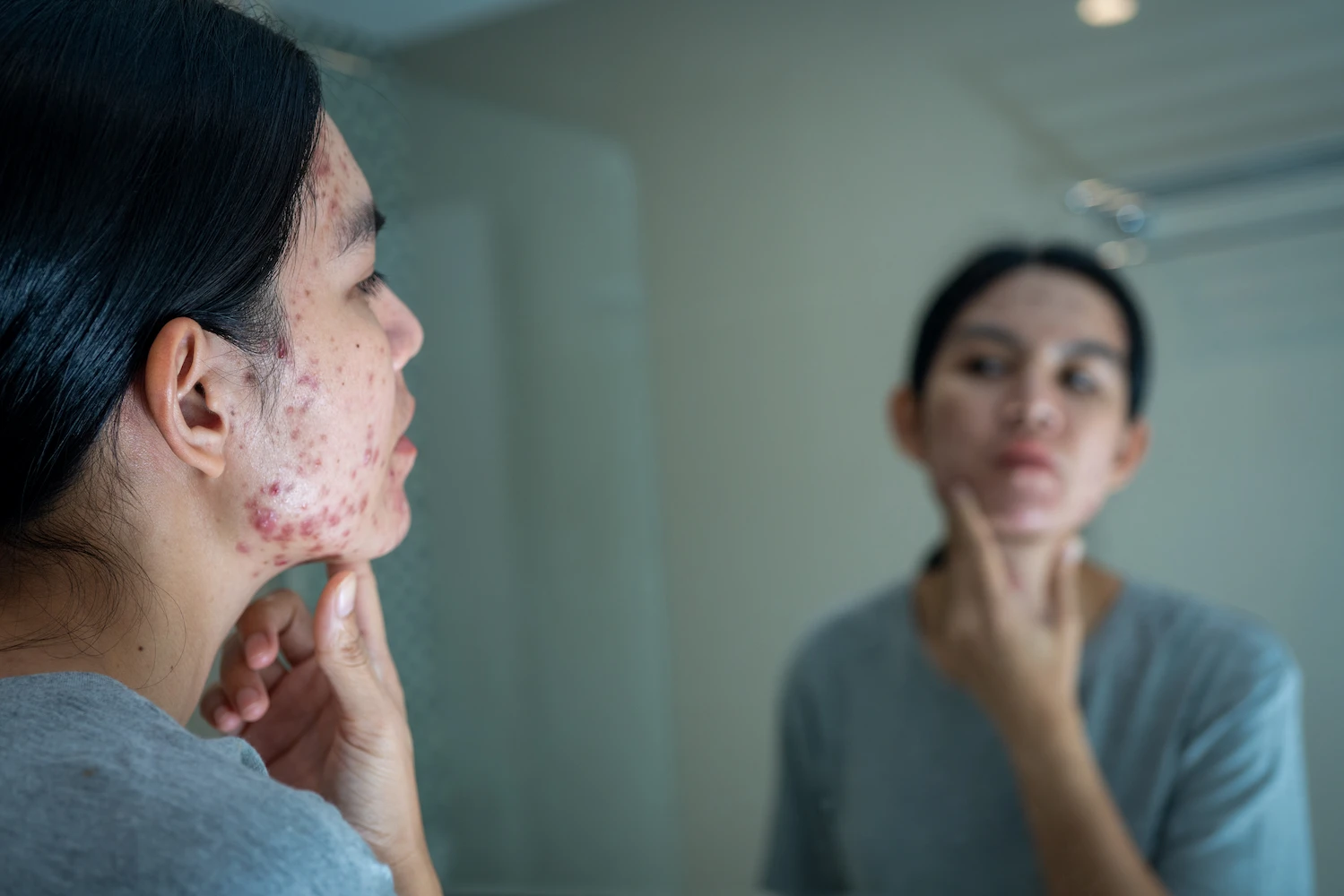Productos dermatológicos recomendados para tratar granos en la piel y acné vulgar