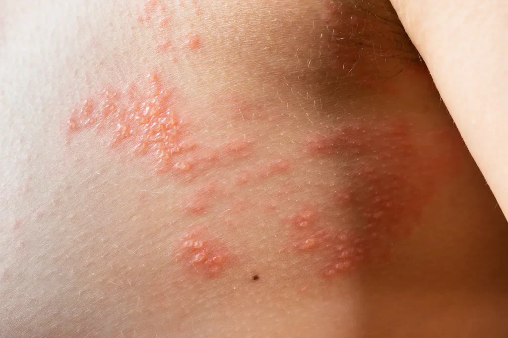Dermatóloga evaluando lesiones de psoriasis en consulta especializada