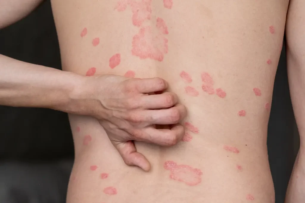 Imagen educativa sobre tipos de psoriasis placas, gotas, inversa, uñas y pustulosa