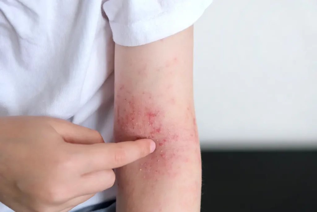 Mujer revisando una placa en el brazo para identificar como empieza la psoriasis