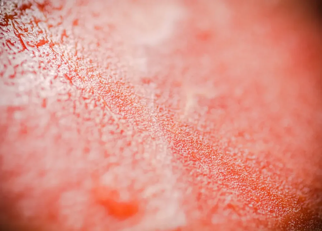 Primer plano de piel con descamación para explicar psoriasis causas y síntomas