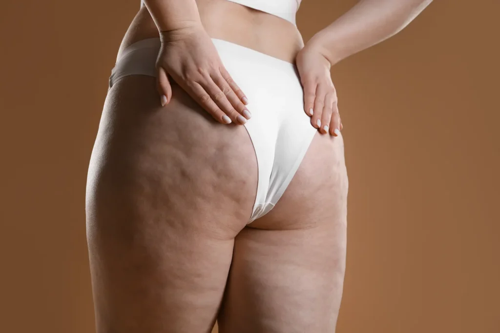 el mejor tratamiento celulitis thaliderm