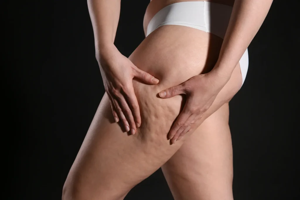 tratamiento celulitis thaliderm