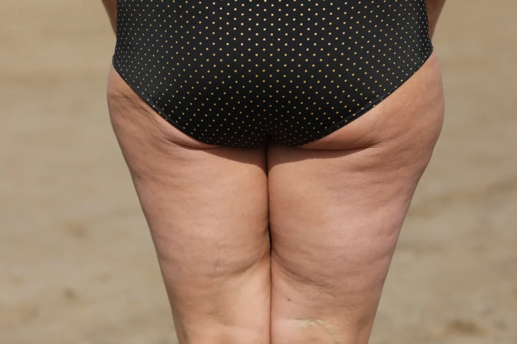 tratamiento de celulitis thaliderm
