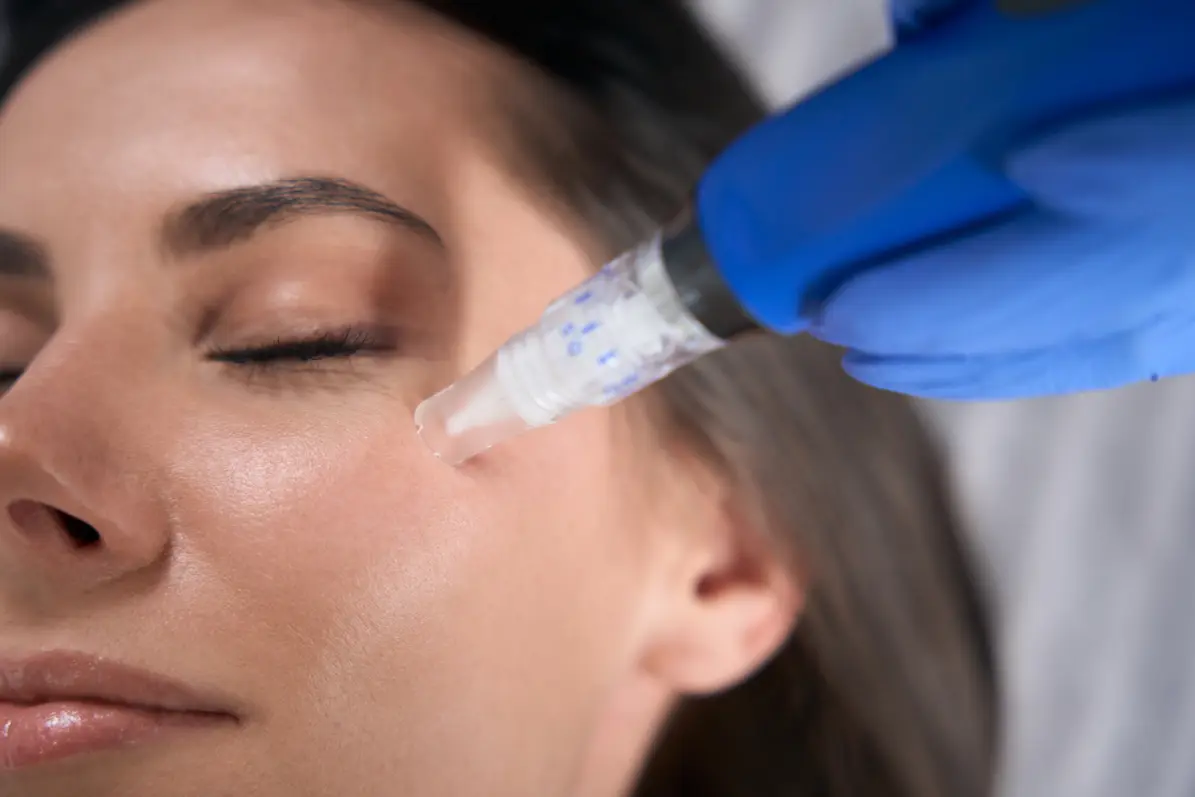 Paciente recibiendo la aplicación de un sérum de ácido hialurónico tras una sesión de dermapen, mostrando para qué sirve este paso en la hidratación profunda de la piel.