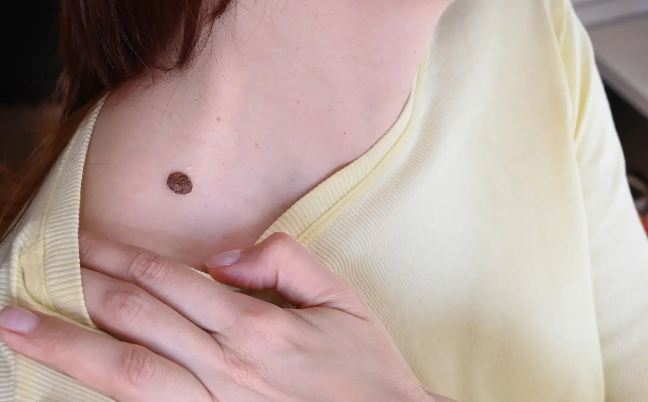 Dermatofibroma en la pierna de una mujer adulta, nódulo firme de color marrón claro