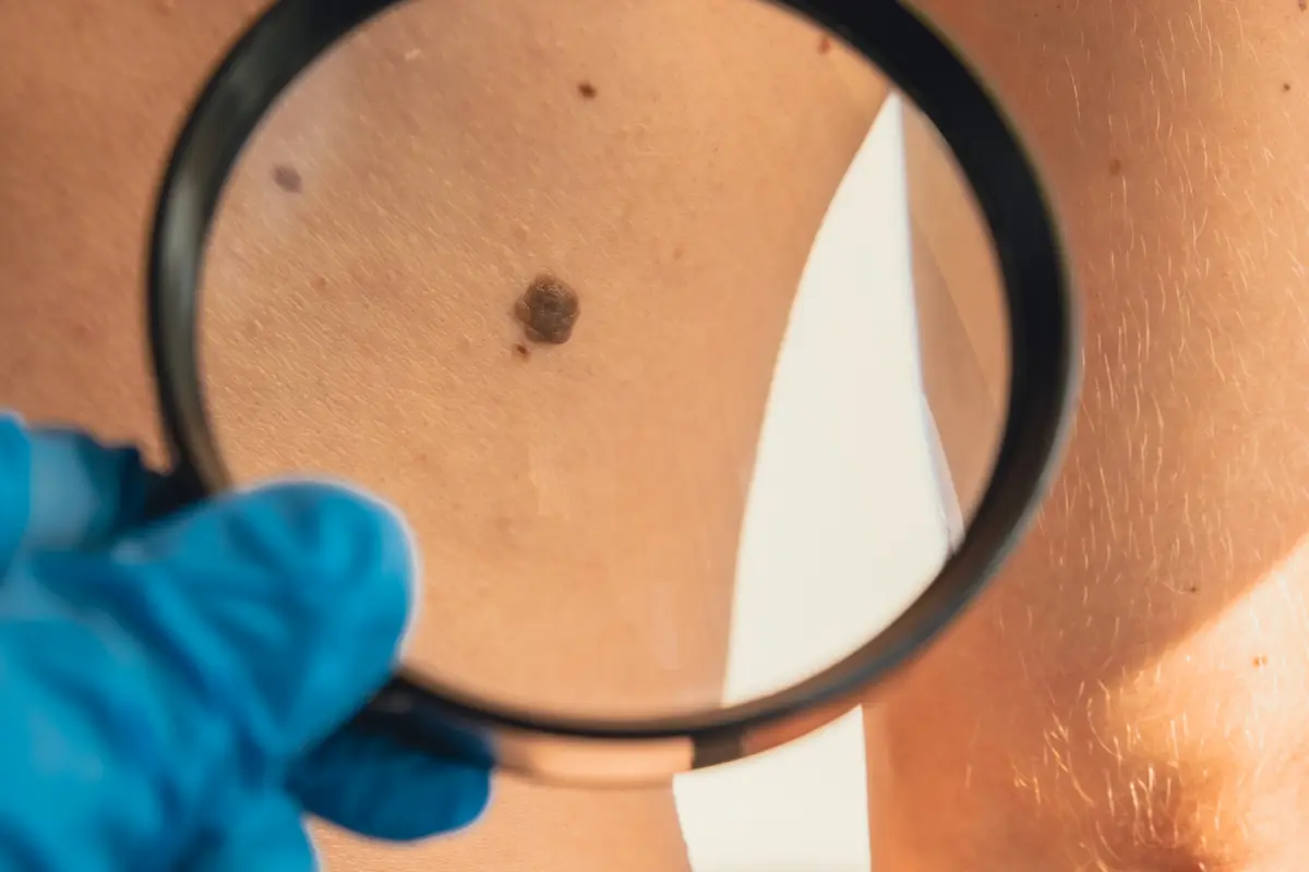 Dermatólogo revisando lunares cancerígenos con dermatoscopio en una consulta en Quito