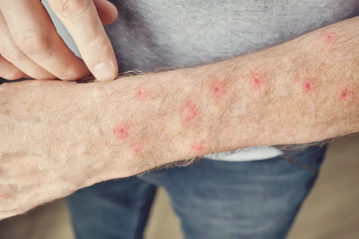 Primer plano de puntos rojos en la piel del antebrazo de un adulto